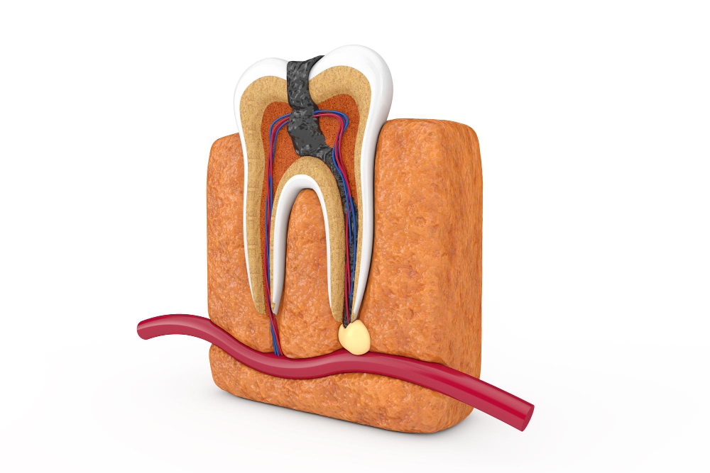 Travel of decay inside of a tooth.